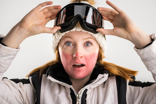 A blonde skißer pushes up her goggles to show severely sunburned nose. cheeks, and chin.